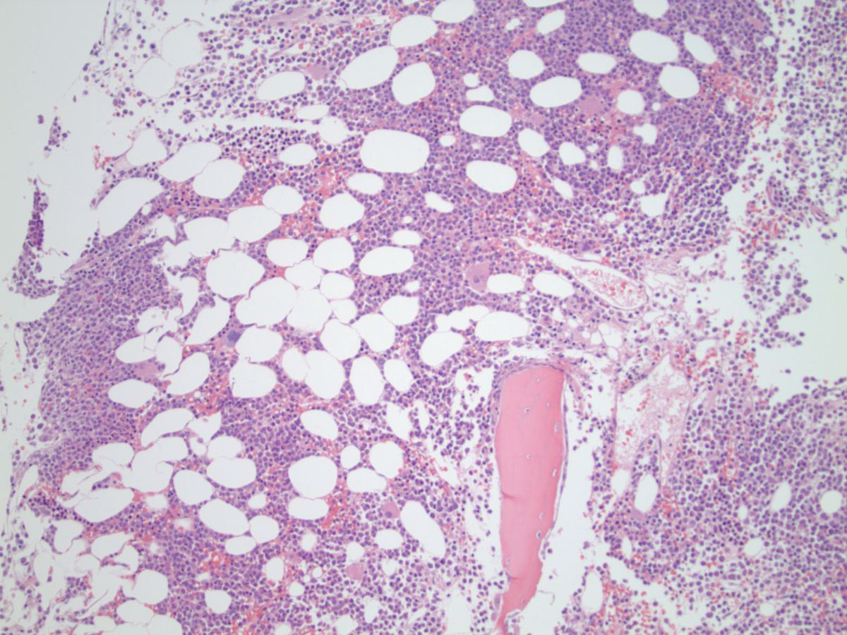 Bone marrow biopsy (100X) showing a hypercellular marrow with immature granulocytic precursors comprising the majority of marrow elements